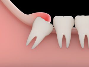 shutterstock 327915770-brazos-valley-oral-surgery-college-station-tx
